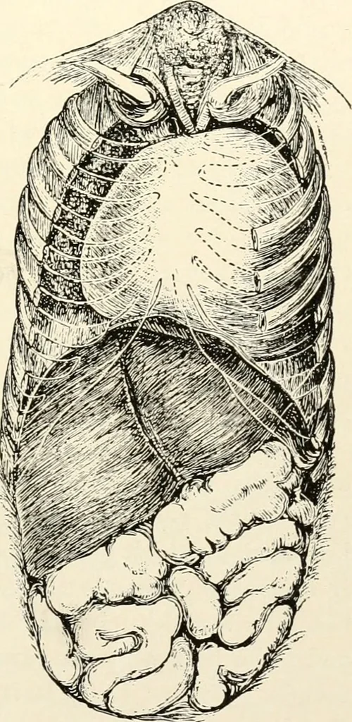 An illustration from Diseases of the heart and arterial system : designed to be a practical presentation of the subject for the use of students and practitioners of medicine / by Robert H. Babcock ... with three coloured plates and one hundred and thirty-nine illustrations., 1903, leaf 97