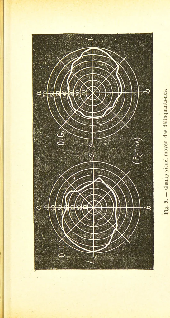An illustration from Nouvelles recherches de psychiatrie et d'anthropologie criminelle / par Cesare Lombroso., 1892, leaf 101