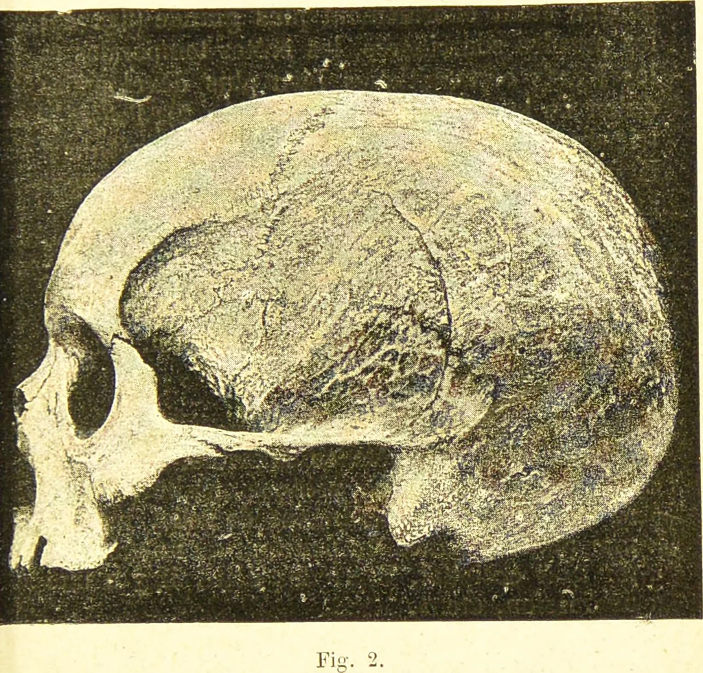 An illustration from Nouvelles recherches de psychiatrie et d'anthropologie criminelle / par Cesare Lombroso., 1892, leaf 35
