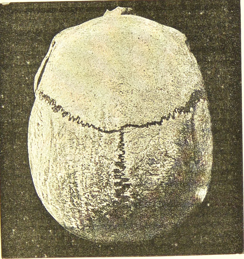 An illustration from Nouvelles recherches de psychiatrie et d'anthropologie criminelle / par Cesare Lombroso., 1892, leaf 37