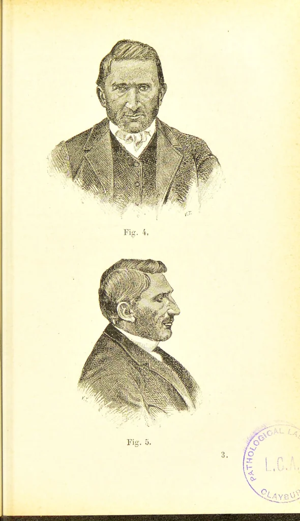 An illustration from Nouvelles recherches de psychiatrie et d'anthropologie criminelle / par Cesare Lombroso., 1892, leaf 53