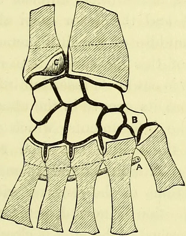 An illustration from A course of operative surgery / with plates drawn from nature by M. Léveillé and coloured by hand under his direction ; by Christopher Heath., 1877, leaf 127