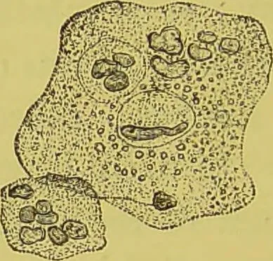 An illustration from Lectures on syphilitic and vaccino-syphilitic inoculations : their prevention, diagnosis, and treatment. Illustrated by coloured plates / by Henry Lee., 1863, leaf 36