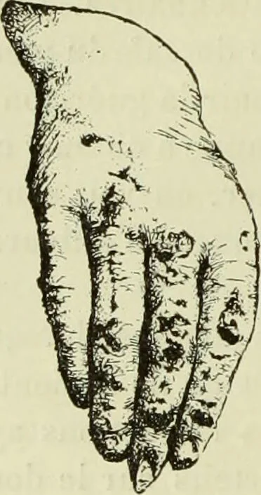 An illustration from Traité pratique et théorique de la lèpre / par Henri Leloir., 1886, leaf 106