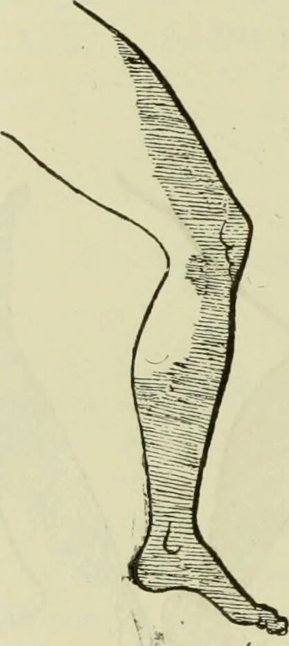 An illustration from Traité pratique et théorique de la lèpre / par Henri Leloir., 1886, leaf 168