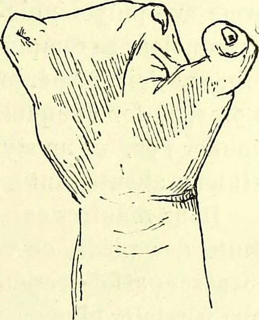 An illustration from Traité pratique et théorique de la lèpre / par Henri Leloir., 1886, leaf 183
