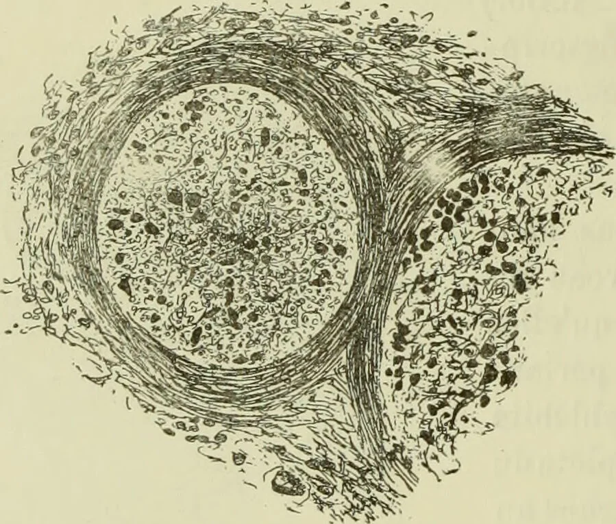 An illustration from Traité pratique et théorique de la lèpre / par Henri Leloir., 1886, leaf 256