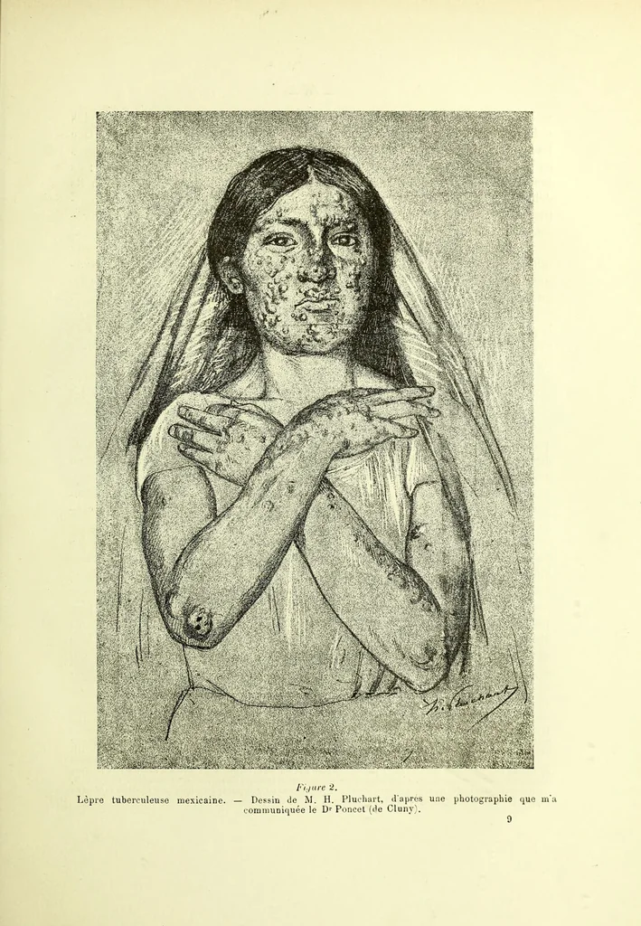 An illustration from Traité pratique et théorique de la lèpre / par Henri Leloir., 1886, leaf 75