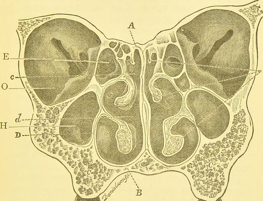 An illustration from Diseases of the nose and throat / by F. de Havilland Hall ... With 2 coloured plates and 59 illustrations., 1894, leaf 147