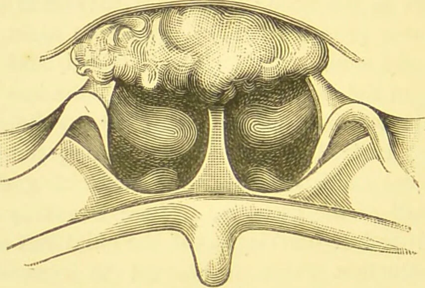 An illustration from Diseases of the nose and throat / by F. de Havilland Hall ... With 2 coloured plates and 59 illustrations., 1894, leaf 172