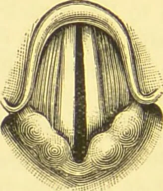 An illustration from Diseases of the nose and throat / by F. de Havilland Hall ... With 2 coloured plates and 59 illustrations., 1894, leaf 474