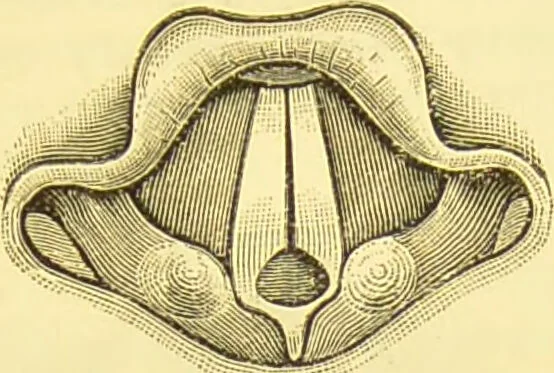 An illustration from Diseases of the nose and throat / by F. de Havilland Hall ... With 2 coloured plates and 59 illustrations., 1894, leaf 487