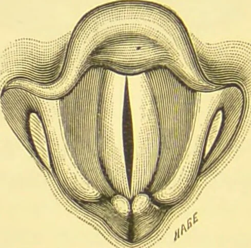 An illustration from Diseases of the nose and throat / by F. de Havilland Hall ... With 2 coloured plates and 59 illustrations., 1894, leaf 488