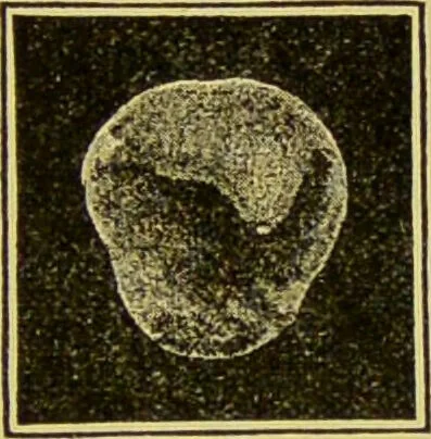 An illustration from Diseases of the ear, nose, and throat and their accessory cavities : A condensed text-book / By Seth Scott Bishop., 1897, leaf 101