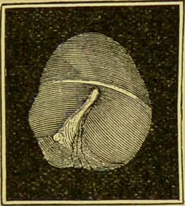 An illustration from Diseases of the ear, nose, and throat and their accessory cavities : A condensed text-book / By Seth Scott Bishop., 1897, leaf 103
