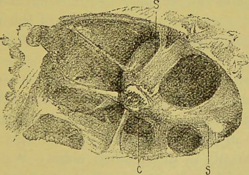 An illustration from Diseases of the ear, nose, and throat and their accessory cavities : A condensed text-book / By Seth Scott Bishop., 1897, leaf 111