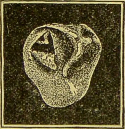 An illustration from Diseases of the ear, nose, and throat and their accessory cavities : A condensed text-book / By Seth Scott Bishop., 1897, leaf 127