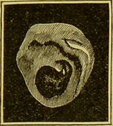 An illustration from Diseases of the ear, nose, and throat and their accessory cavities : A condensed text-book / By Seth Scott Bishop., 1897, leaf 137