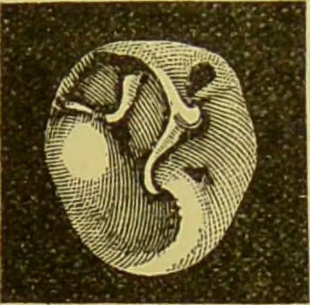 An illustration from Diseases of the ear, nose, and throat and their accessory cavities : A condensed text-book / By Seth Scott Bishop., 1897, leaf 137