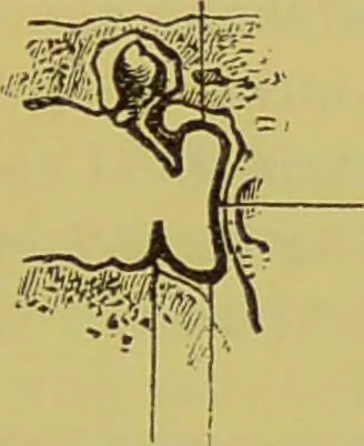 An illustration from Diseases of the ear, nose, and throat and their accessory cavities : A condensed text-book / By Seth Scott Bishop., 1897, leaf 149