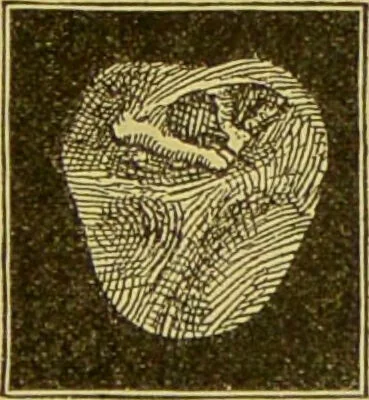 An illustration from Diseases of the ear, nose, and throat and their accessory cavities : A condensed text-book / By Seth Scott Bishop., 1897, leaf 149
