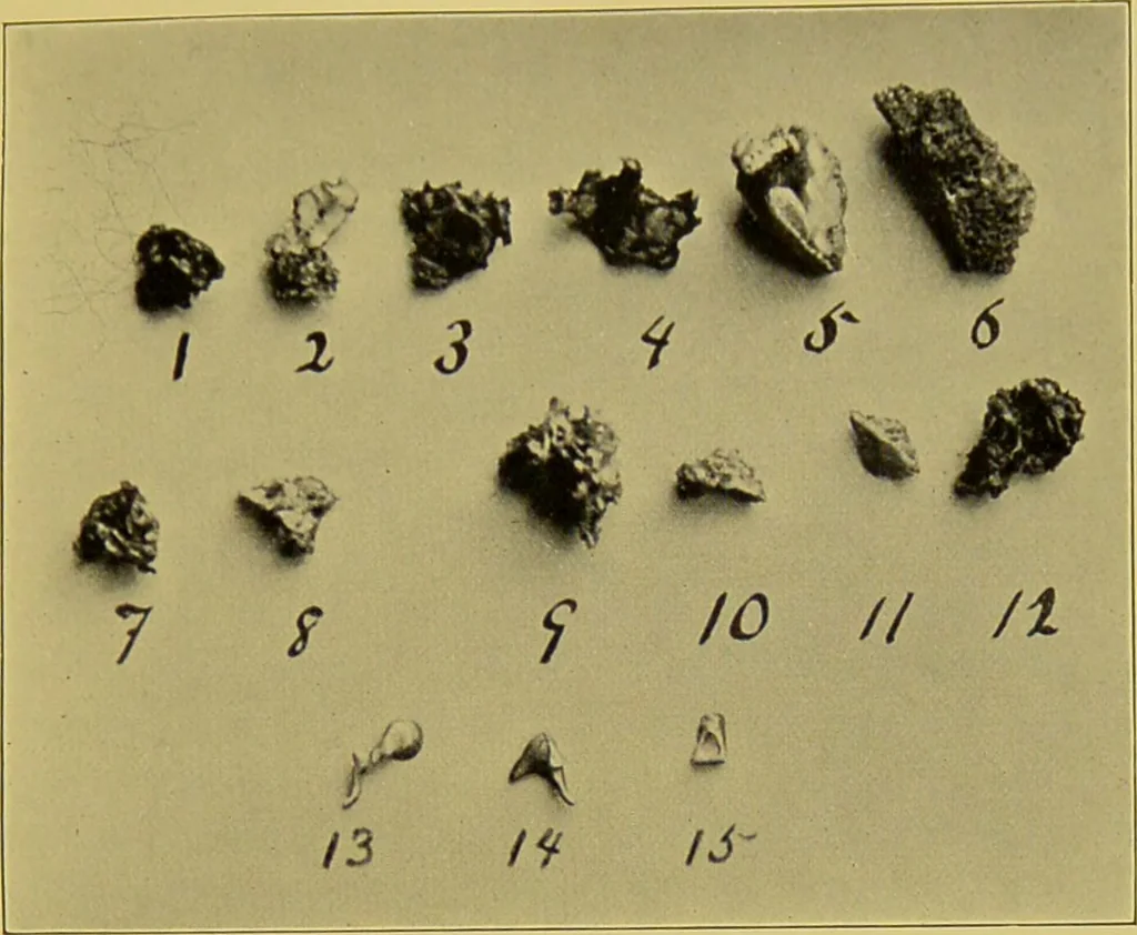 An illustration from Diseases of the ear, nose, and throat and their accessory cavities : A condensed text-book / By Seth Scott Bishop., 1897, leaf 159