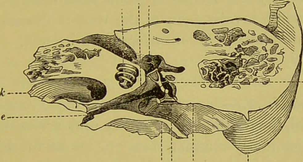An illustration from Diseases of the ear, nose, and throat and their accessory cavities : A condensed text-book / By Seth Scott Bishop., 1897, leaf 163