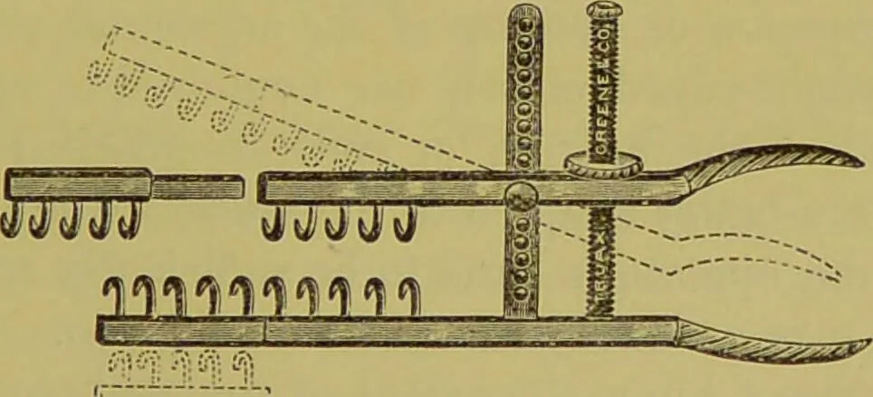 An illustration from Diseases of the ear, nose, and throat and their accessory cavities : A condensed text-book / By Seth Scott Bishop., 1897, leaf 183