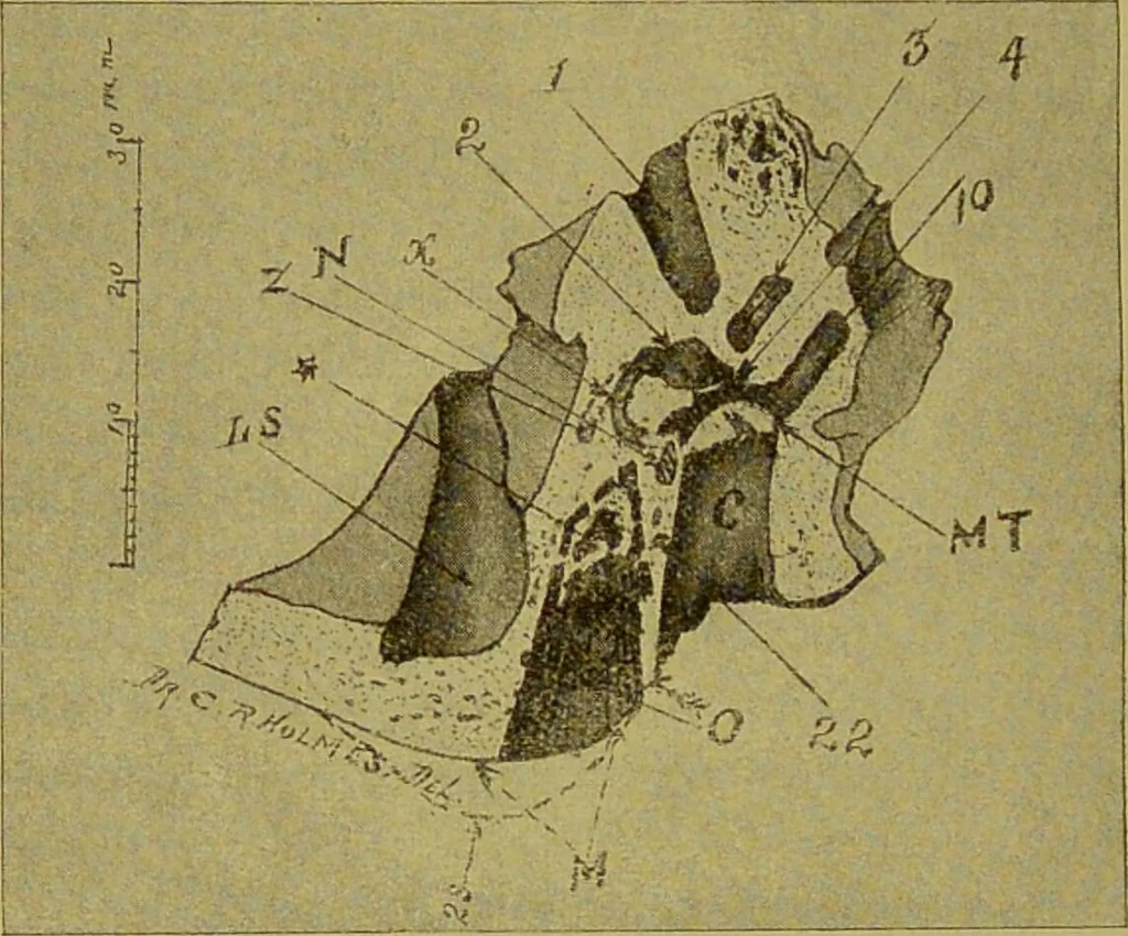 An illustration from Diseases of the ear, nose, and throat and their accessory cavities : A condensed text-book / By Seth Scott Bishop., 1897, leaf 186