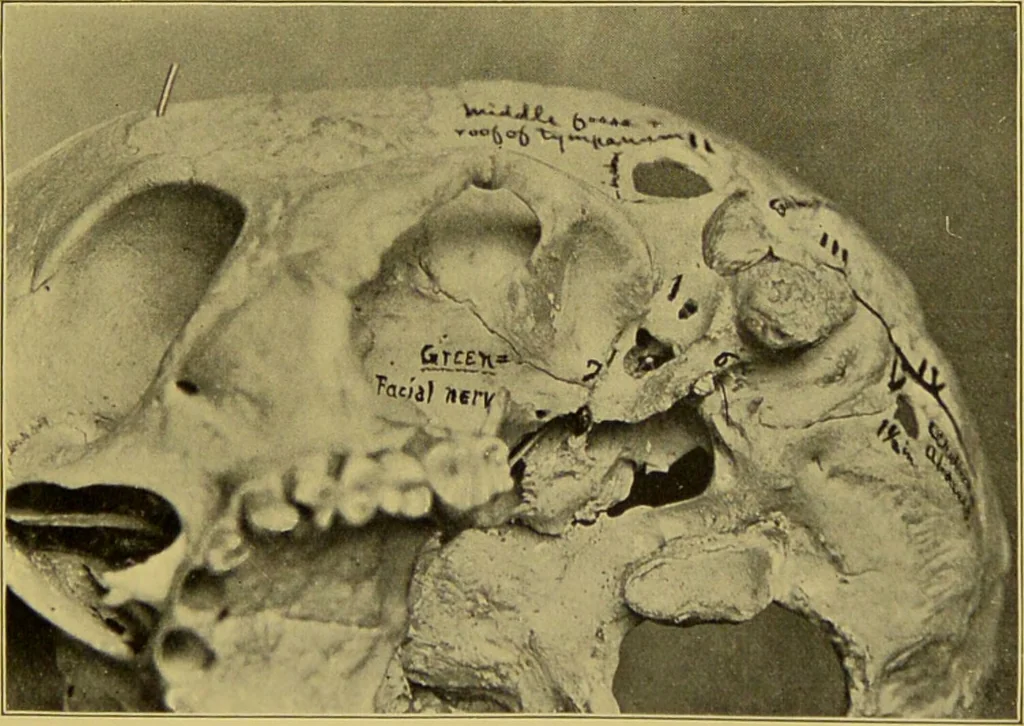 An illustration from Diseases of the ear, nose, and throat and their accessory cavities : A condensed text-book / By Seth Scott Bishop., 1897, leaf 187