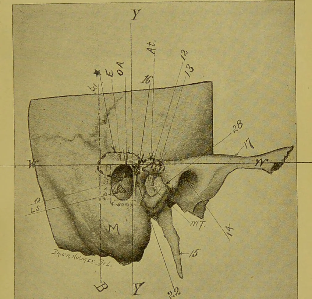 An illustration from Diseases of the ear, nose, and throat and their accessory cavities : A condensed text-book / By Seth Scott Bishop., 1897, leaf 189
