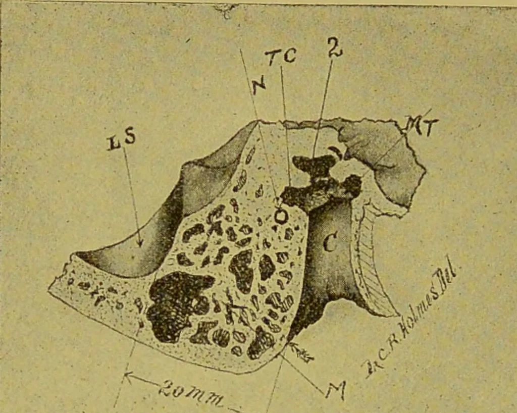 An illustration from Diseases of the ear, nose, and throat and their accessory cavities : A condensed text-book / By Seth Scott Bishop., 1897, leaf 190