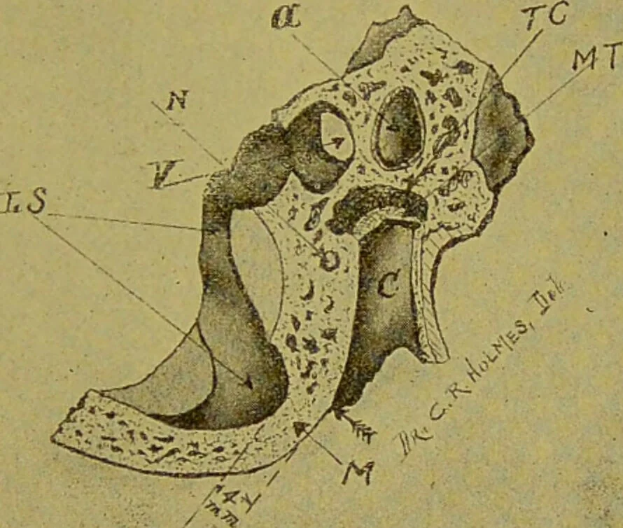 An illustration from Diseases of the ear, nose, and throat and their accessory cavities : A condensed text-book / By Seth Scott Bishop., 1897, leaf 191