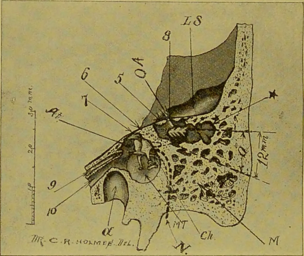 An illustration from Diseases of the ear, nose, and throat and their accessory cavities : A condensed text-book / By Seth Scott Bishop., 1897, leaf 192