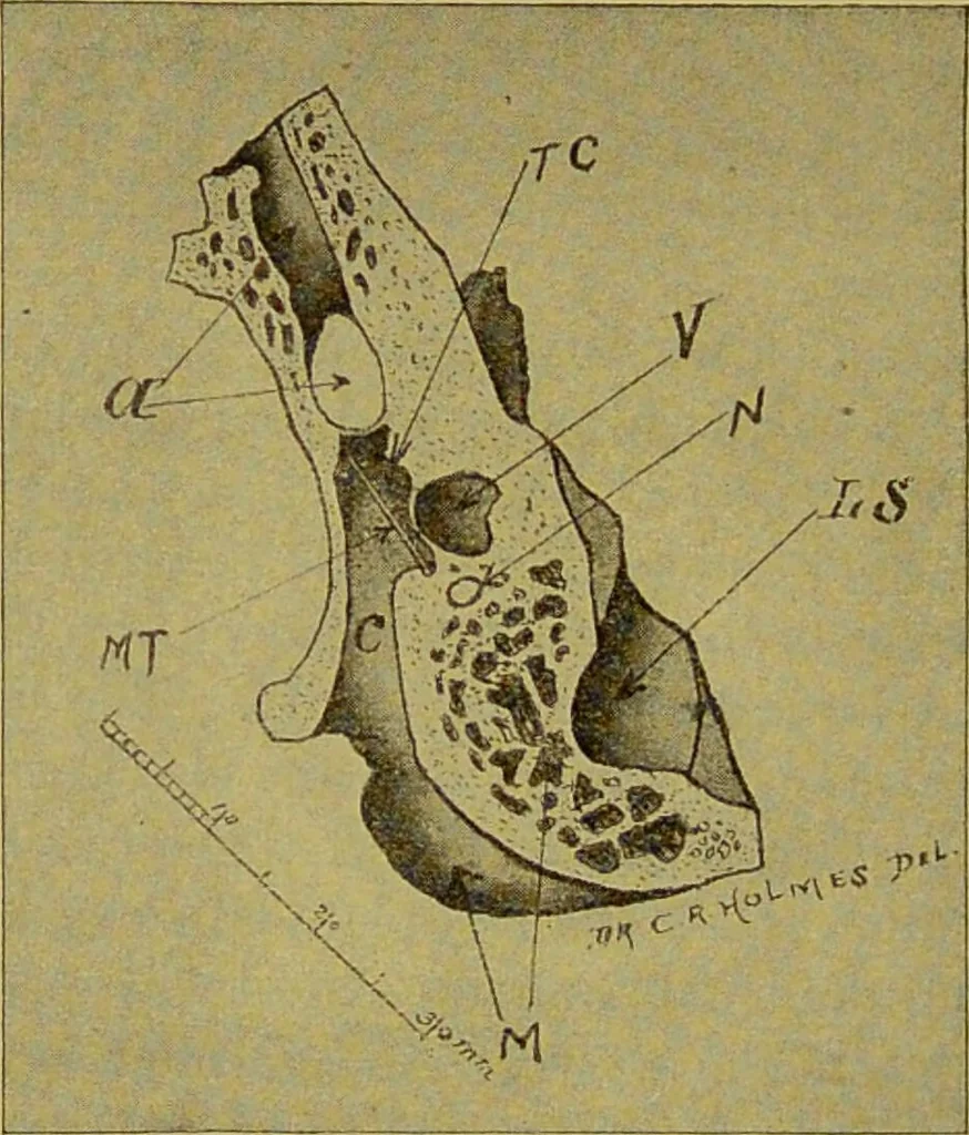 An illustration from Diseases of the ear, nose, and throat and their accessory cavities : A condensed text-book / By Seth Scott Bishop., 1897, leaf 202