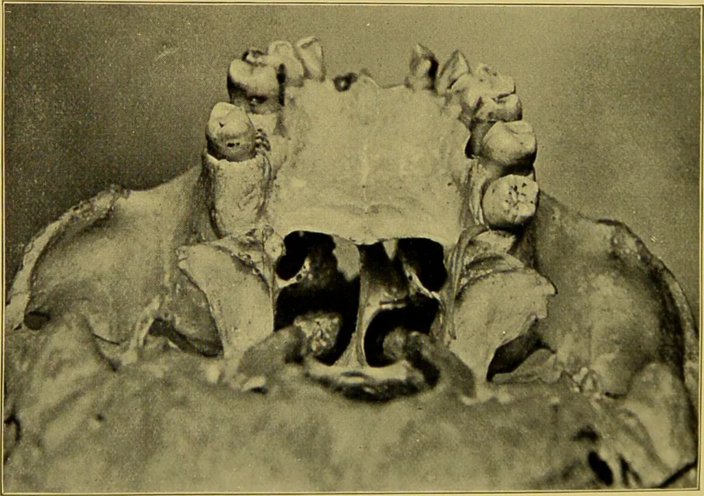 An illustration from Diseases of the ear, nose, and throat and their accessory cavities : A condensed text-book / By Seth Scott Bishop., 1897, leaf 296