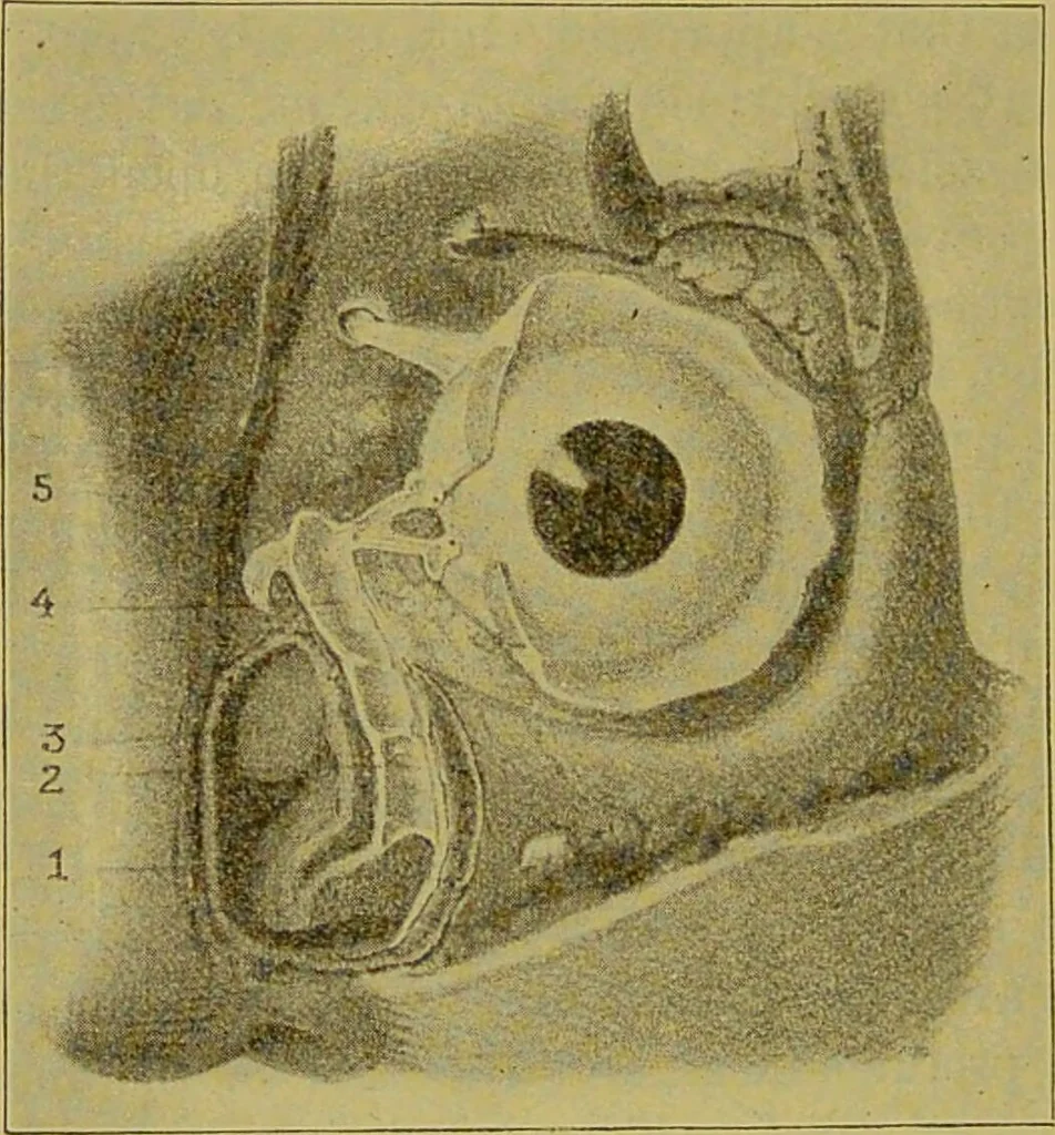 An illustration from Diseases of the ear, nose, and throat and their accessory cavities : A condensed text-book / By Seth Scott Bishop., 1897, leaf 340