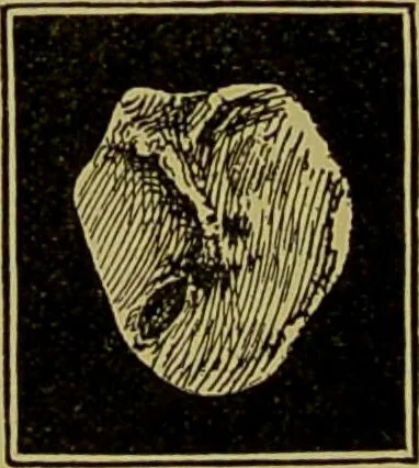 An illustration from Diseases of the ear, nose, and throat and their accessory cavities : A condensed text-book / By Seth Scott Bishop., 1897, leaf 86