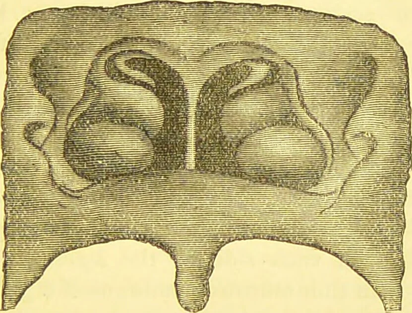 An illustration from Laryngoscopy and rhinoscopy and the diagnosis and treatment of the diseases of the throat and nose / by Prosser James, M.D., 1888, leaf 111