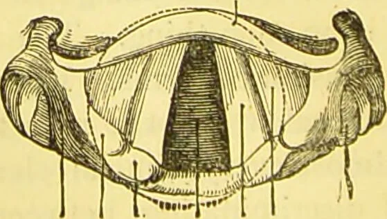 An illustration from Laryngoscopy and rhinoscopy and the diagnosis and treatment of the diseases of the throat and nose / by Prosser James, M.D., 1888, leaf 68