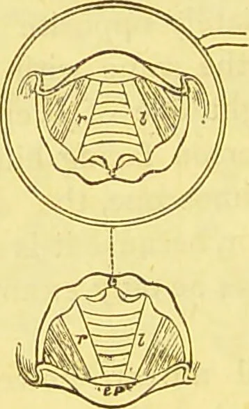 An illustration from Laryngoscopy and rhinoscopy and the diagnosis and treatment of the diseases of the throat and nose / by Prosser James, M.D., 1888, leaf 70