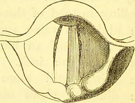 An illustration from Laryngoscopy and rhinoscopy and the diagnosis and treatment of the diseases of the throat and nose / by Prosser James, M.D., 1888, leaf 73