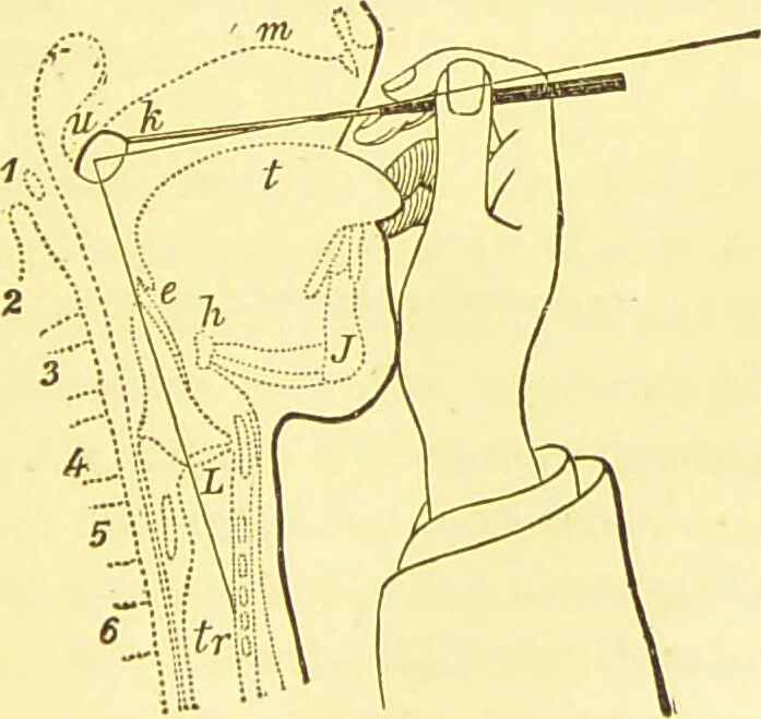An illustration from Laryngoscopy and rhinoscopy and the diagnosis and treatment of the diseases of the throat and nose / by Prosser James, M.D., 1888, leaf 99