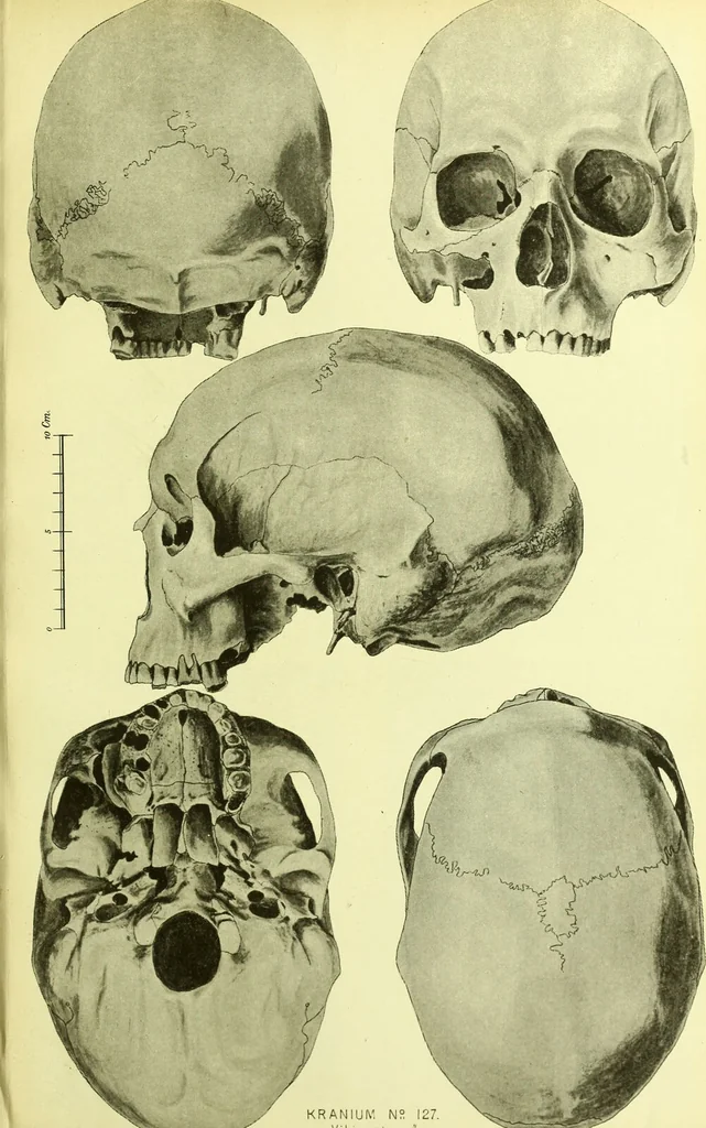 An illustration from Norrønaskaller : crania antiqua in parte orientali Norvegiae meridionalis inventa / en studie fra Universitetets Anatomiske Institut og dette tilegnet af Justus Barth ... ; udgivet ved G.A. Guldberg., 1896, leaf 219