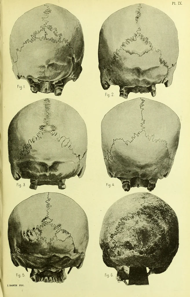 An illustration from Norrønaskaller : crania antiqua in parte orientali Norvegiae meridionalis inventa / en studie fra Universitetets Anatomiske Institut og dette tilegnet af Justus Barth ... ; udgivet ved G.A. Guldberg., 1896, leaf 225