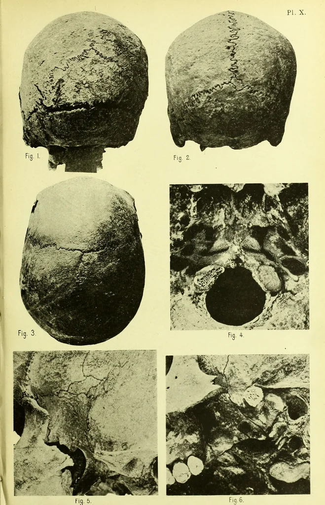 An illustration from Norrønaskaller : crania antiqua in parte orientali Norvegiae meridionalis inventa / en studie fra Universitetets Anatomiske Institut og dette tilegnet af Justus Barth ... ; udgivet ved G.A. Guldberg., 1896, leaf 227