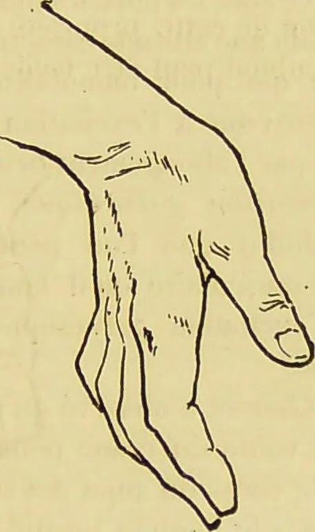 An illustration from Le magnétisme animal / par Alfred Binet et Ch. Féré., 1887, leaf 93