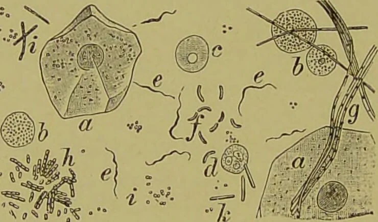 An illustration from Clinical diagnosis : the bacteriological, chemical, and microscopical evidence of disease / By Dr. Rudolf v. Jaksch, ... Translated from the third German edition and enlarged by James Cagney, ... With numerous illustrations (partly in colours)., 1893, leaf 108