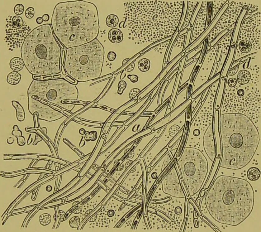 An illustration from Clinical diagnosis : the bacteriological, chemical, and microscopical evidence of disease / By Dr. Rudolf v. Jaksch, ... Translated from the third German edition and enlarged by James Cagney, ... With numerous illustrations (partly in colours)., 1893, leaf 113