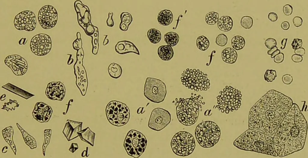 An illustration from Clinical diagnosis : the bacteriological, chemical, and microscopical evidence of disease / By Dr. Rudolf v. Jaksch, ... Translated from the third German edition and enlarged by James Cagney, ... With numerous illustrations (partly in colours)., 1893, leaf 123